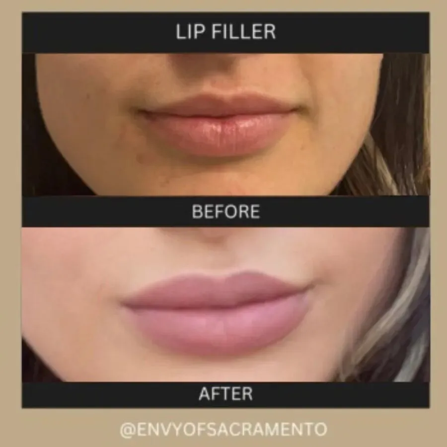 glutathione injection for lips Lip Fillers in Sacramento, CA