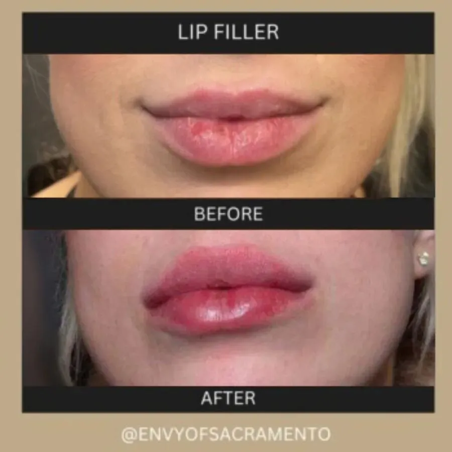 glutathione injection for lips Lip Fillers in Sacramento, CA