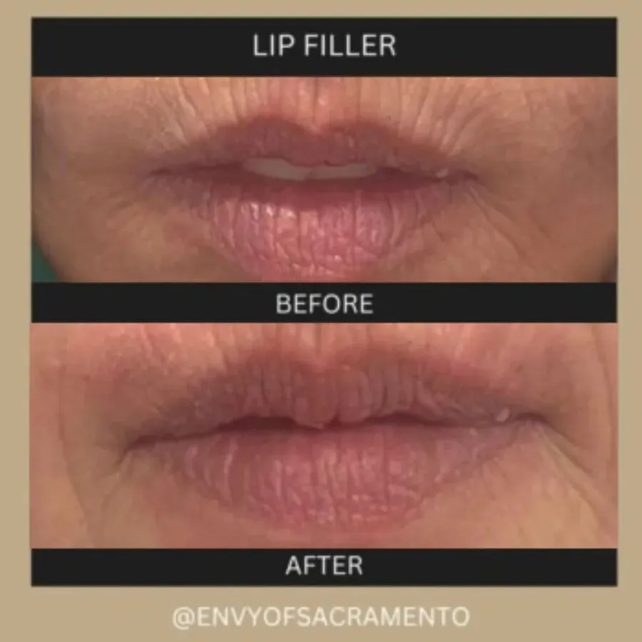 can you smoke cigarettes after lip filler Vertical Lip Line Filler (Smoker's Lines) in Sacramento, CA