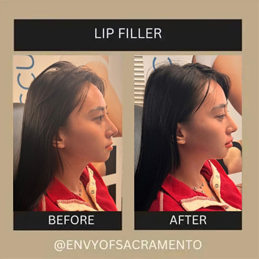 Lip-Filler2.2