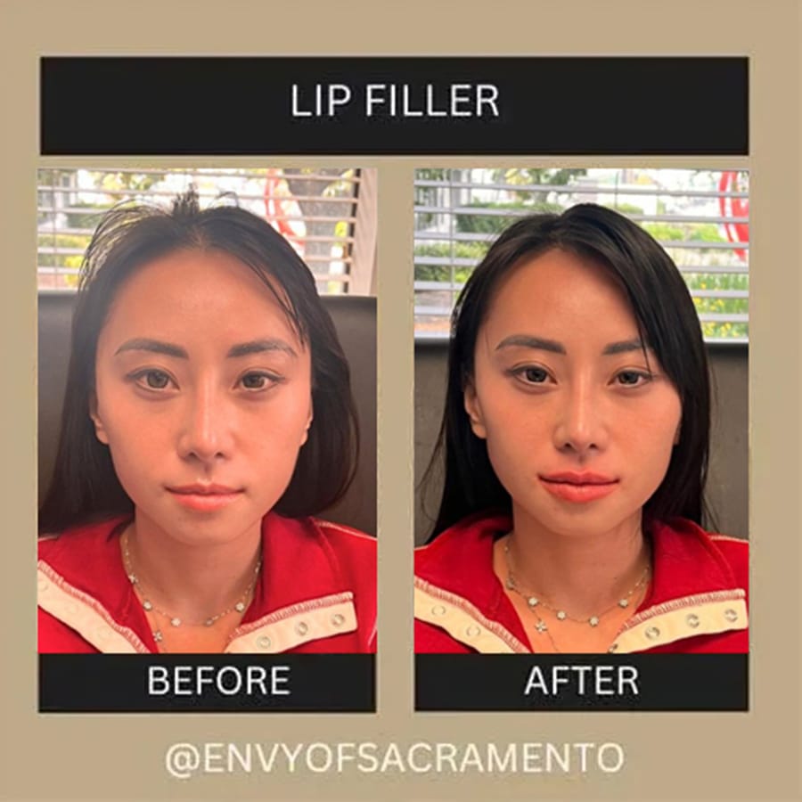 Lip-filler2.1