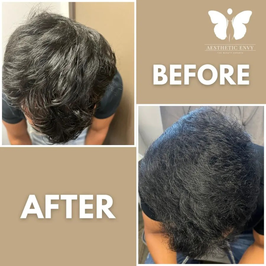 Before and after image of PRP hair restoration results in Roseville.