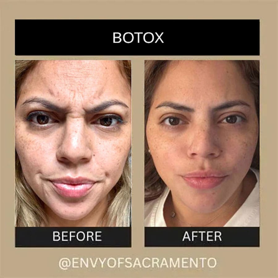 botox-11c