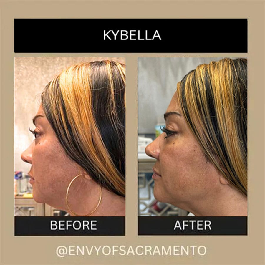 kybella-1a