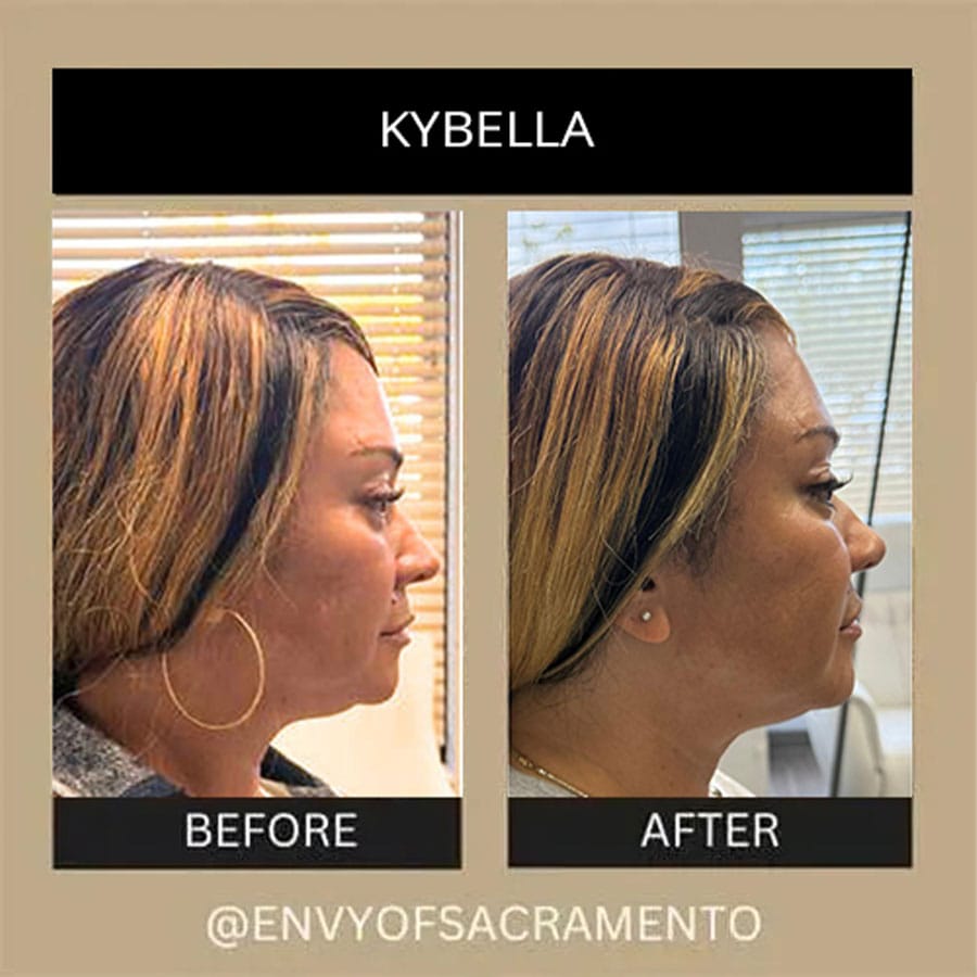 kybella-1b