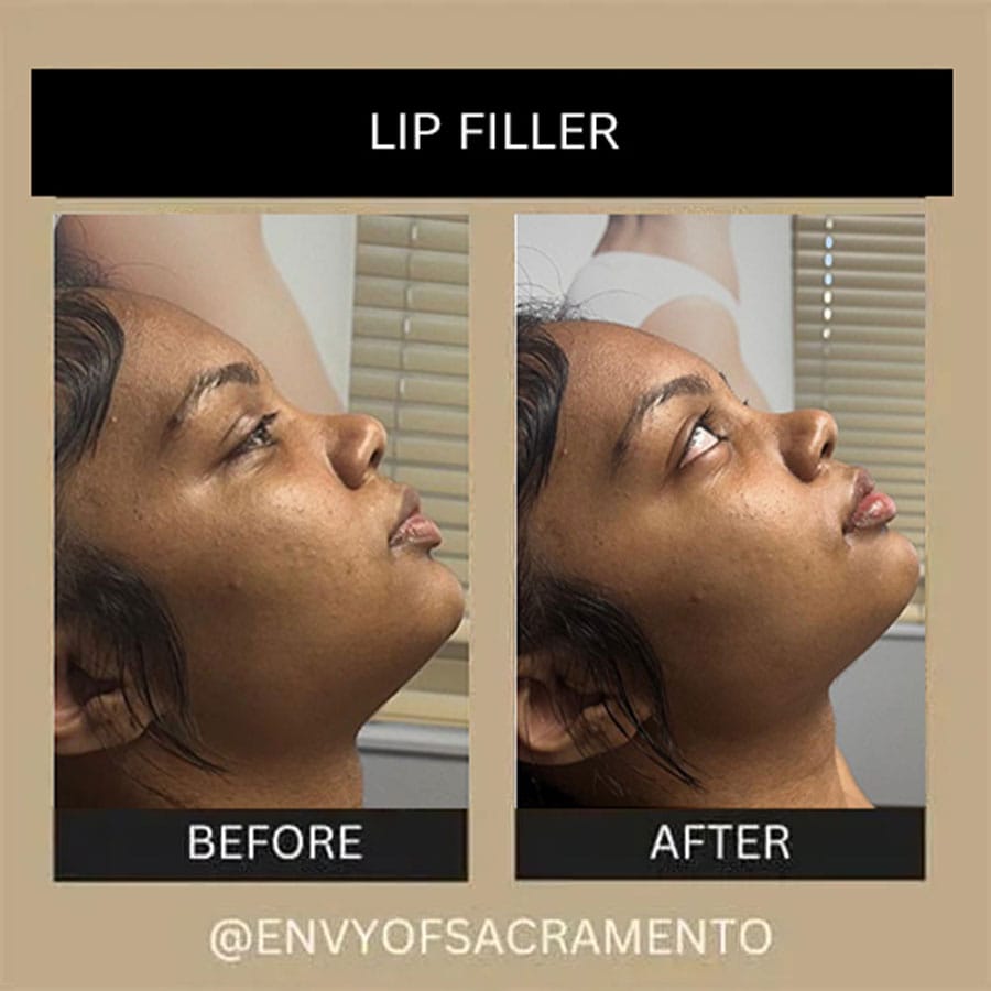 lip-filler-53a
