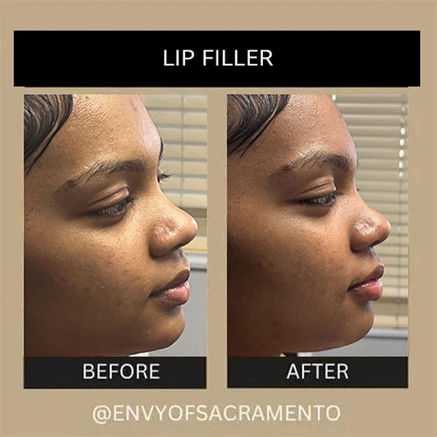 lip-filler-53b