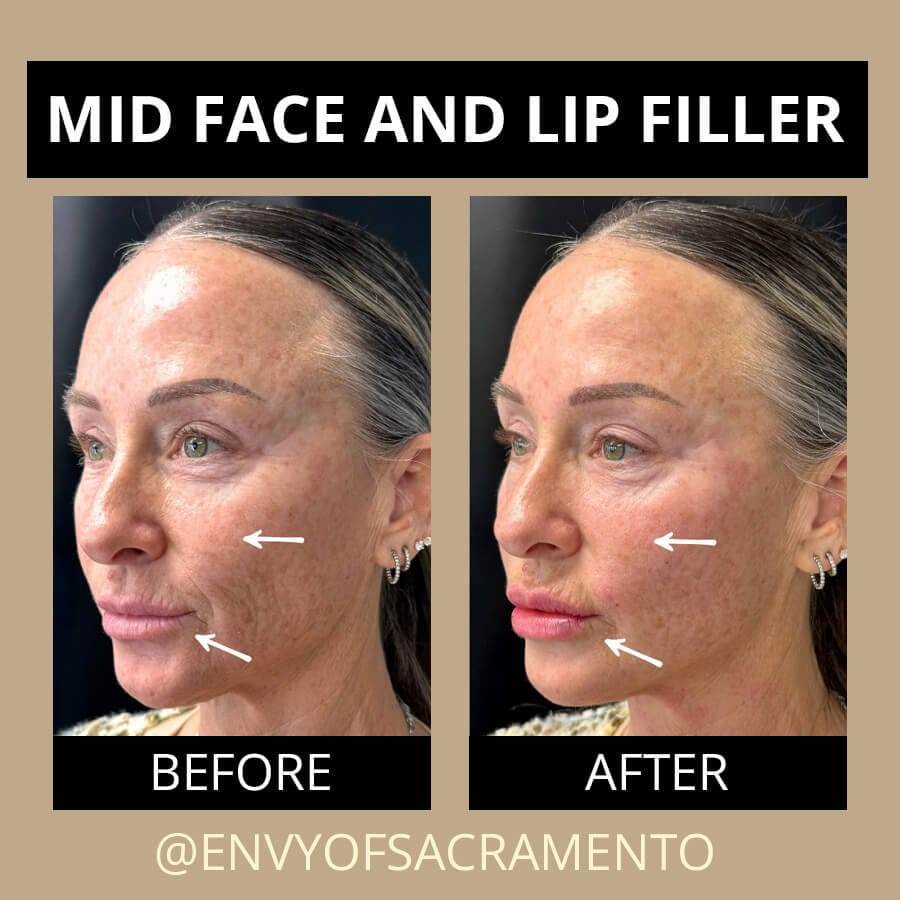 dermal-lip-filler-64