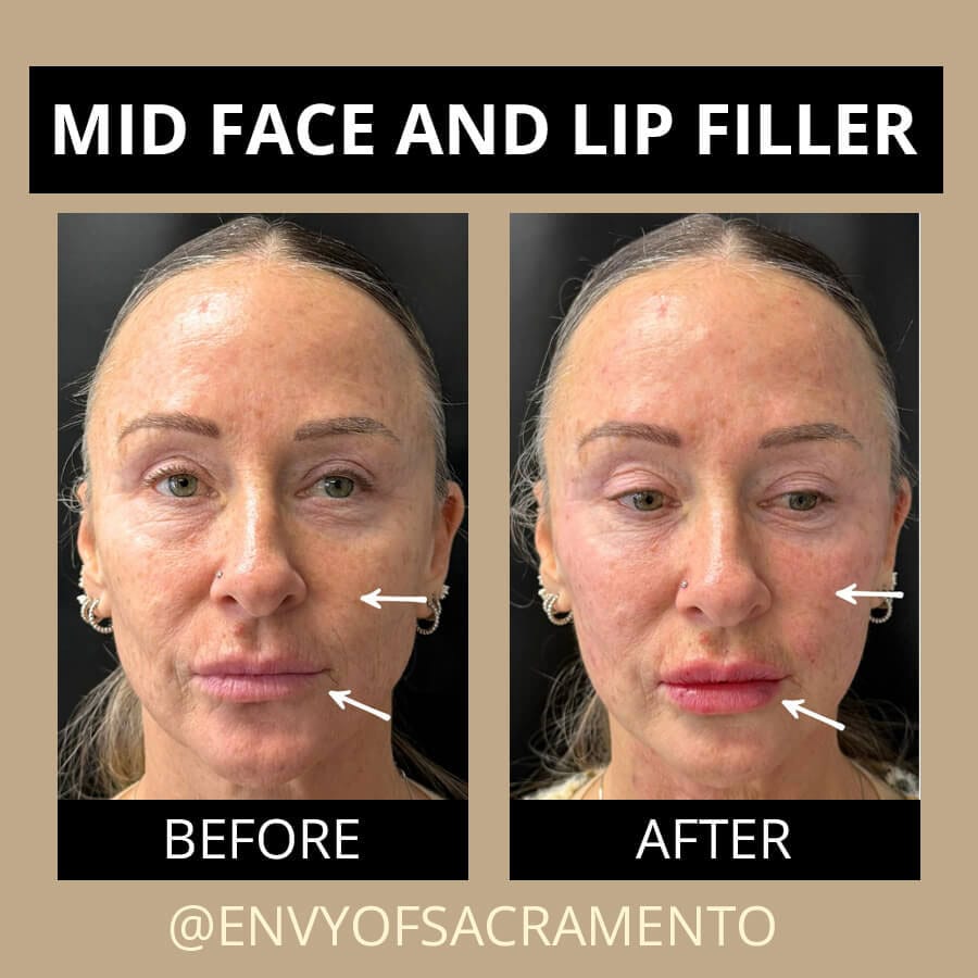 dermal-lip-filler-64b