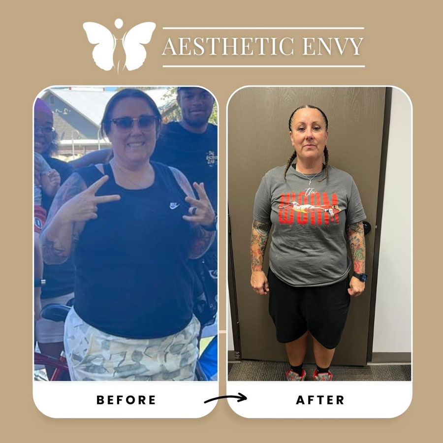 Medical weight loss progress photos from a Roseville patient.