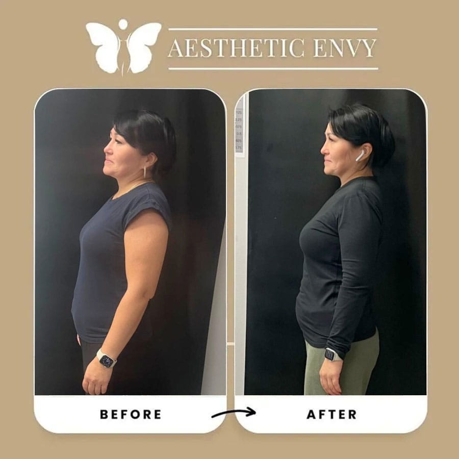Patient transformation with medical weight loss in Roseville, California.