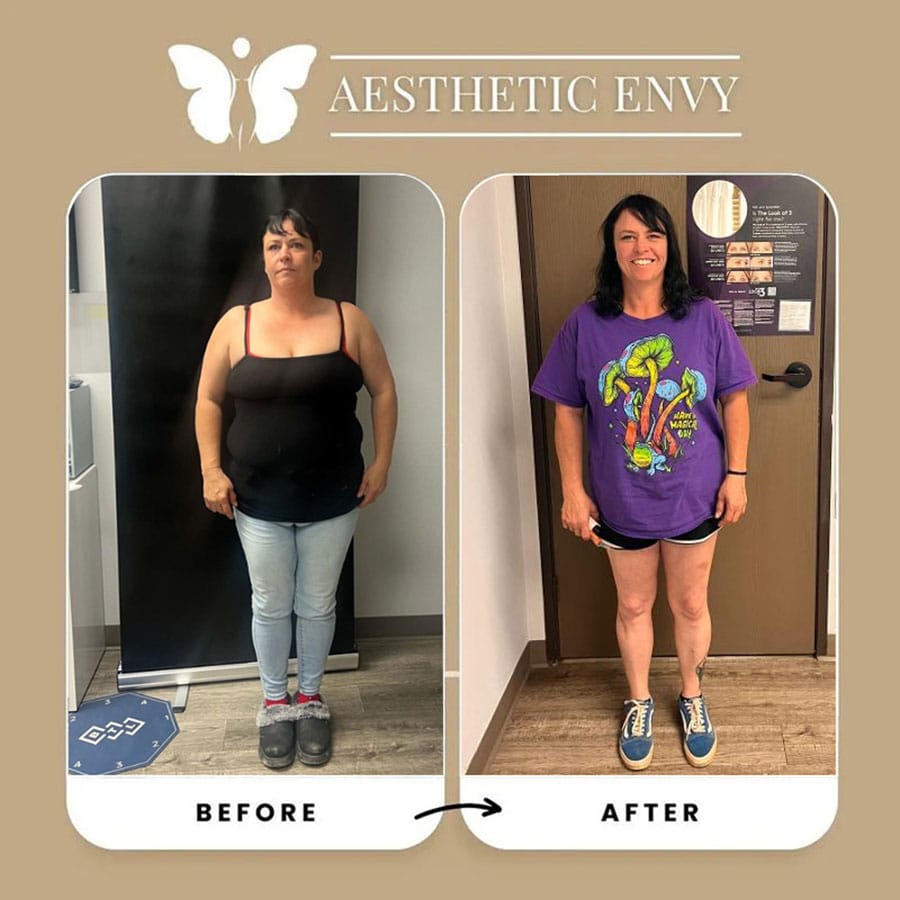 Medical weight loss before and after results for a patient in Roseville, CA