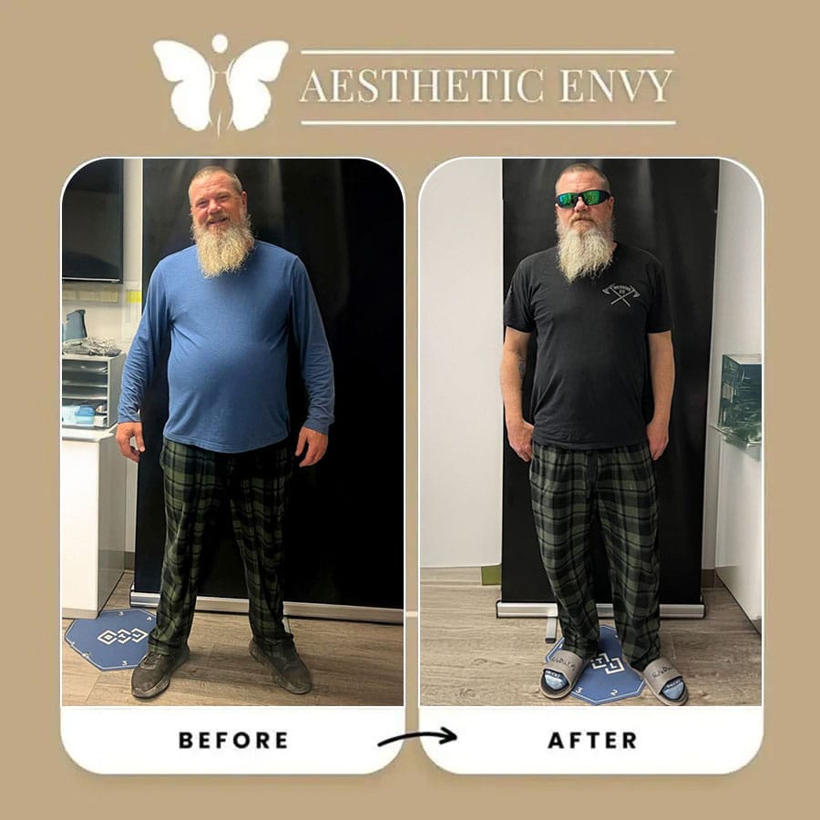 Visible weight loss results with Semaglutide in Roseville.