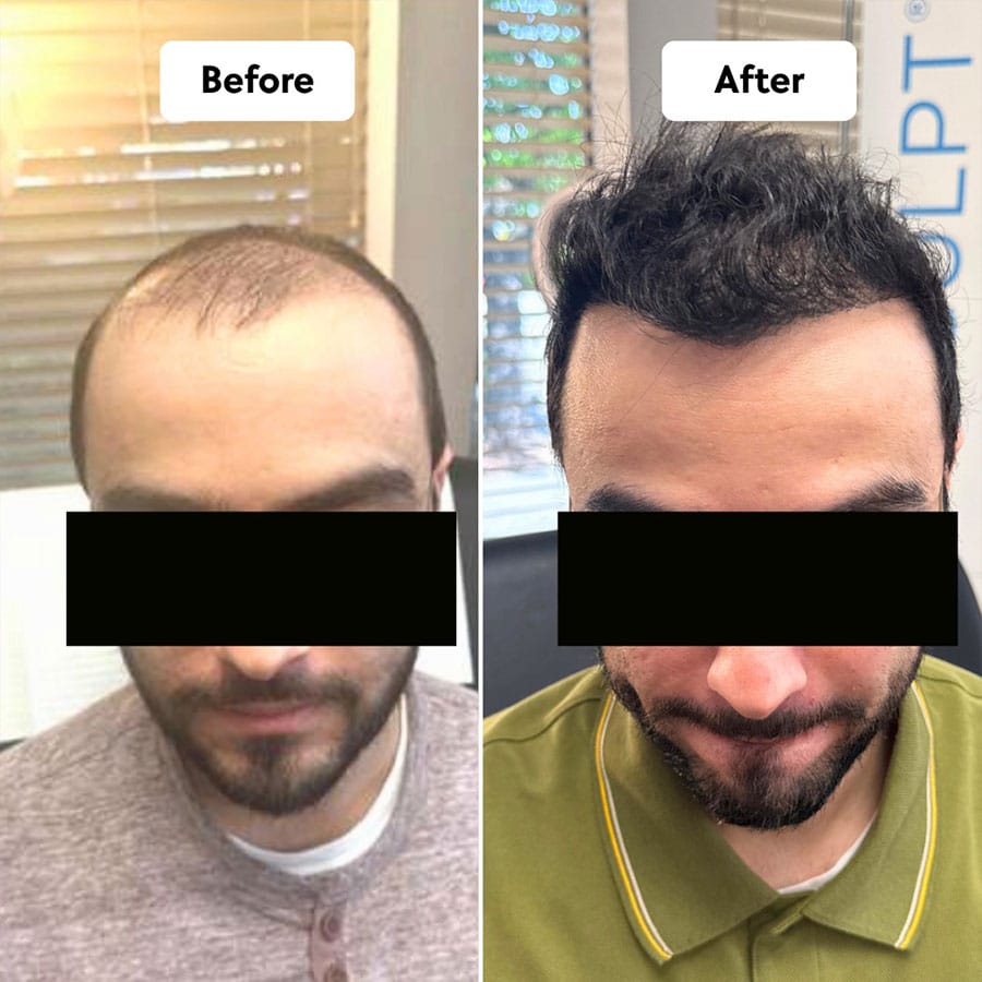 hair-restoration-6a