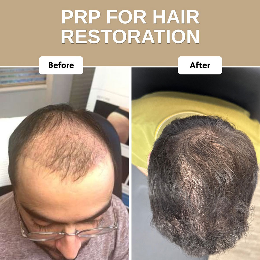 hair-restoration-6b