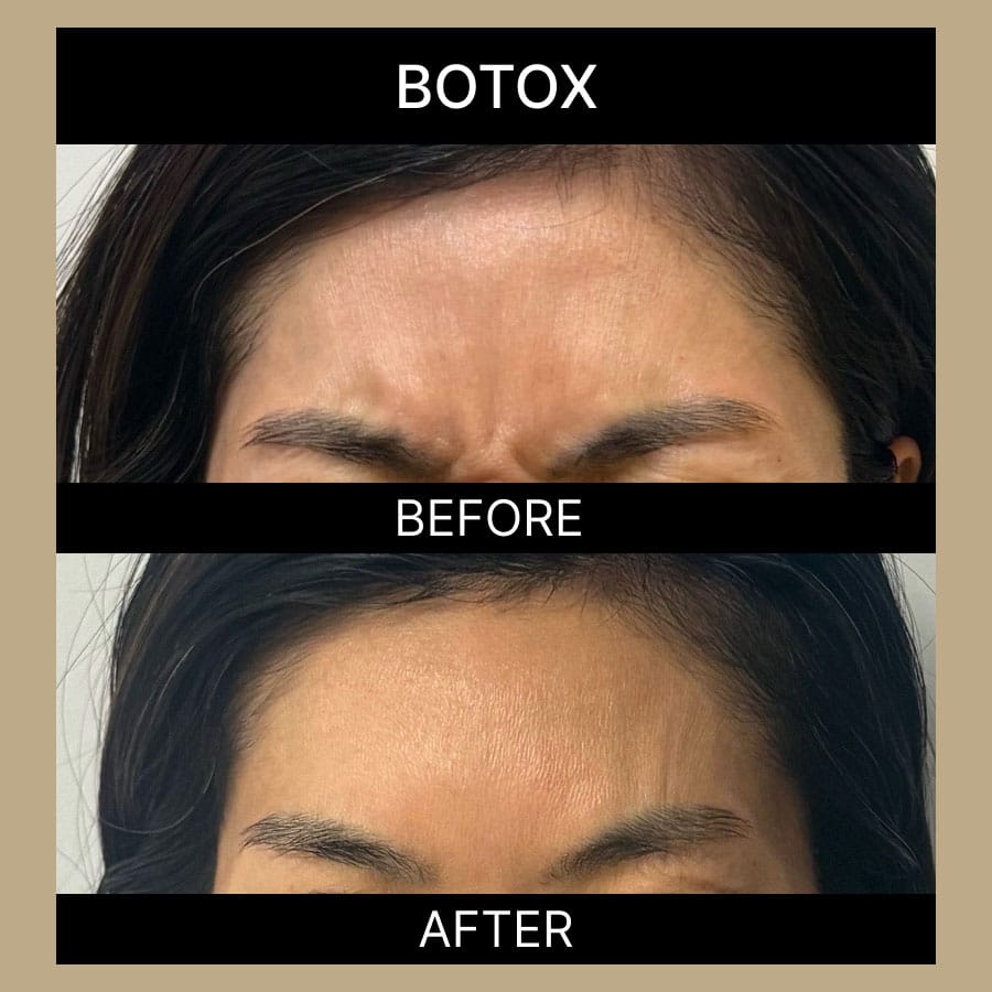 ae-botox-ba-332