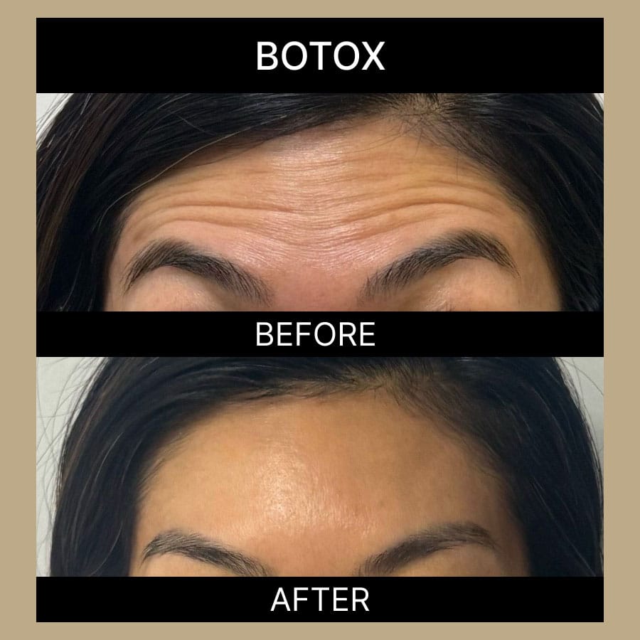 ae-botox-ba-333
