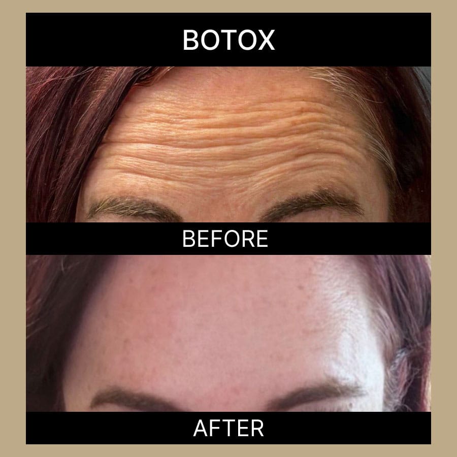 ae-botox-ba-334