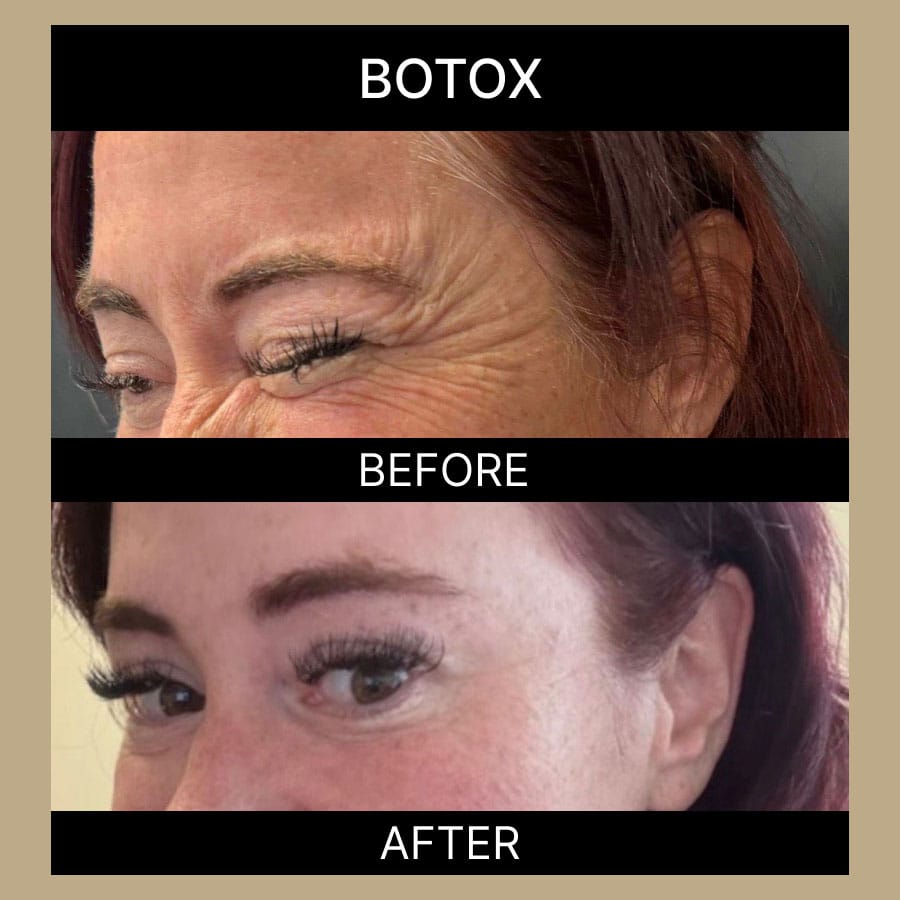 ae-botox-ba-335