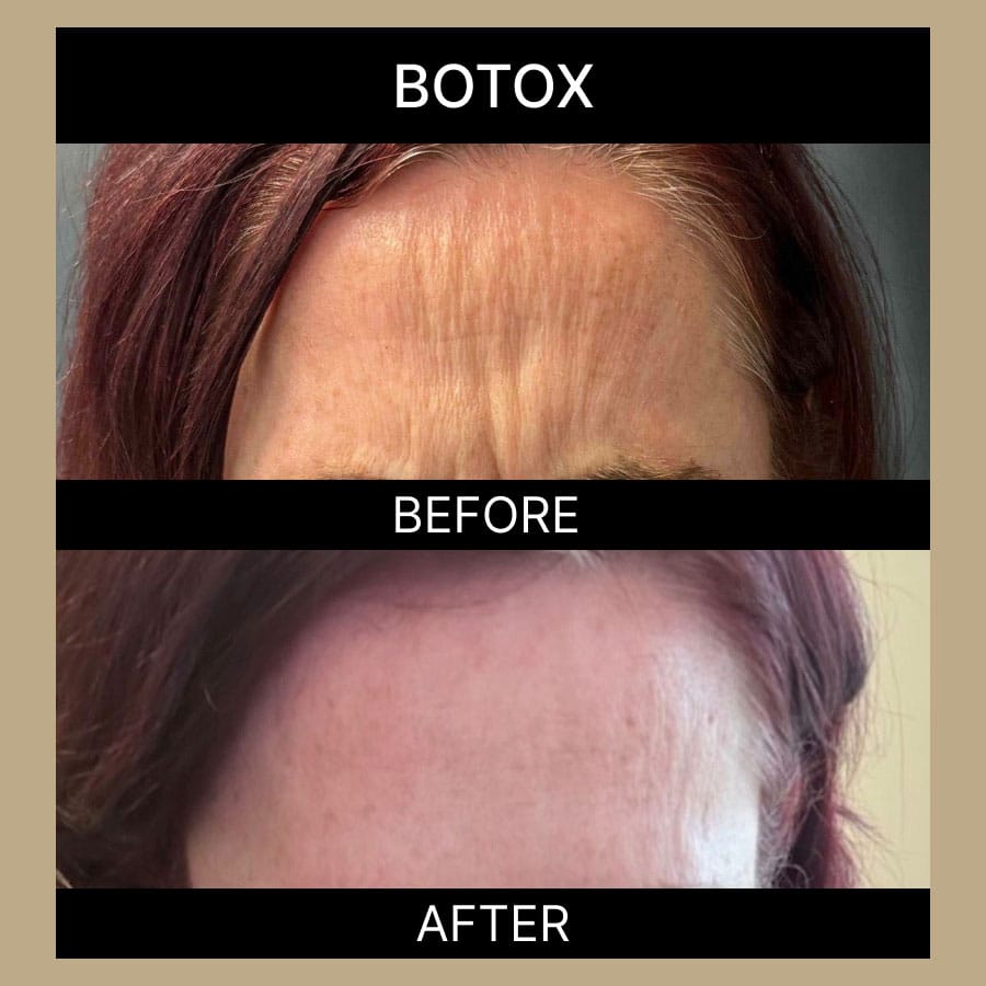 ae-botox-ba-336